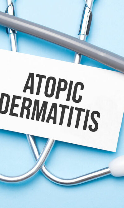 Top 9 Remedies for Atopic Dermatitis